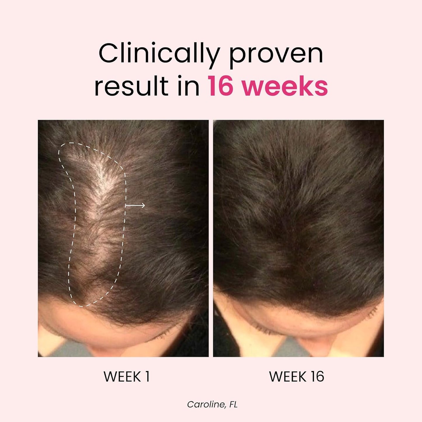 Trybello Anagain™ Hair Growth & Anti-Stress Gummies 3 bottles